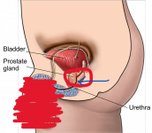 bladder-neck-incision-illustration-9eb35f.png