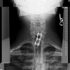 Front view of neck hardware, c6/c7/c8(no bone)/t1 all fused together Thanksgiving day last year ('18)