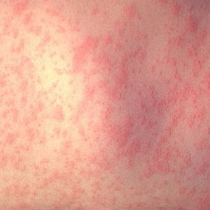 Skin Rash: Causes and Treatments
