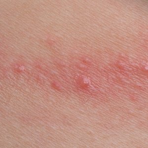 Understanding the Different Types of Skin Rashes