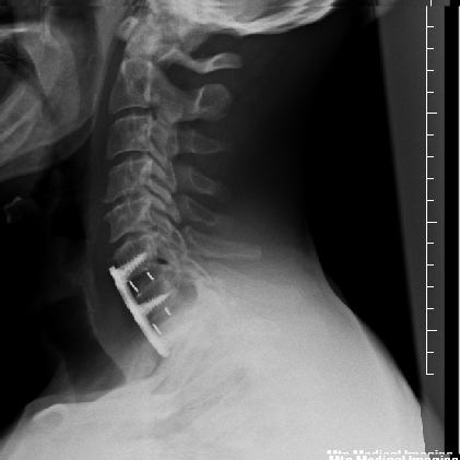 Side view of neck hardware, c6/c7/c8(no bone)/t1 all fused together Thanksgiving day last year ('18)