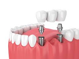 The Importance of Regular Dental Checkups