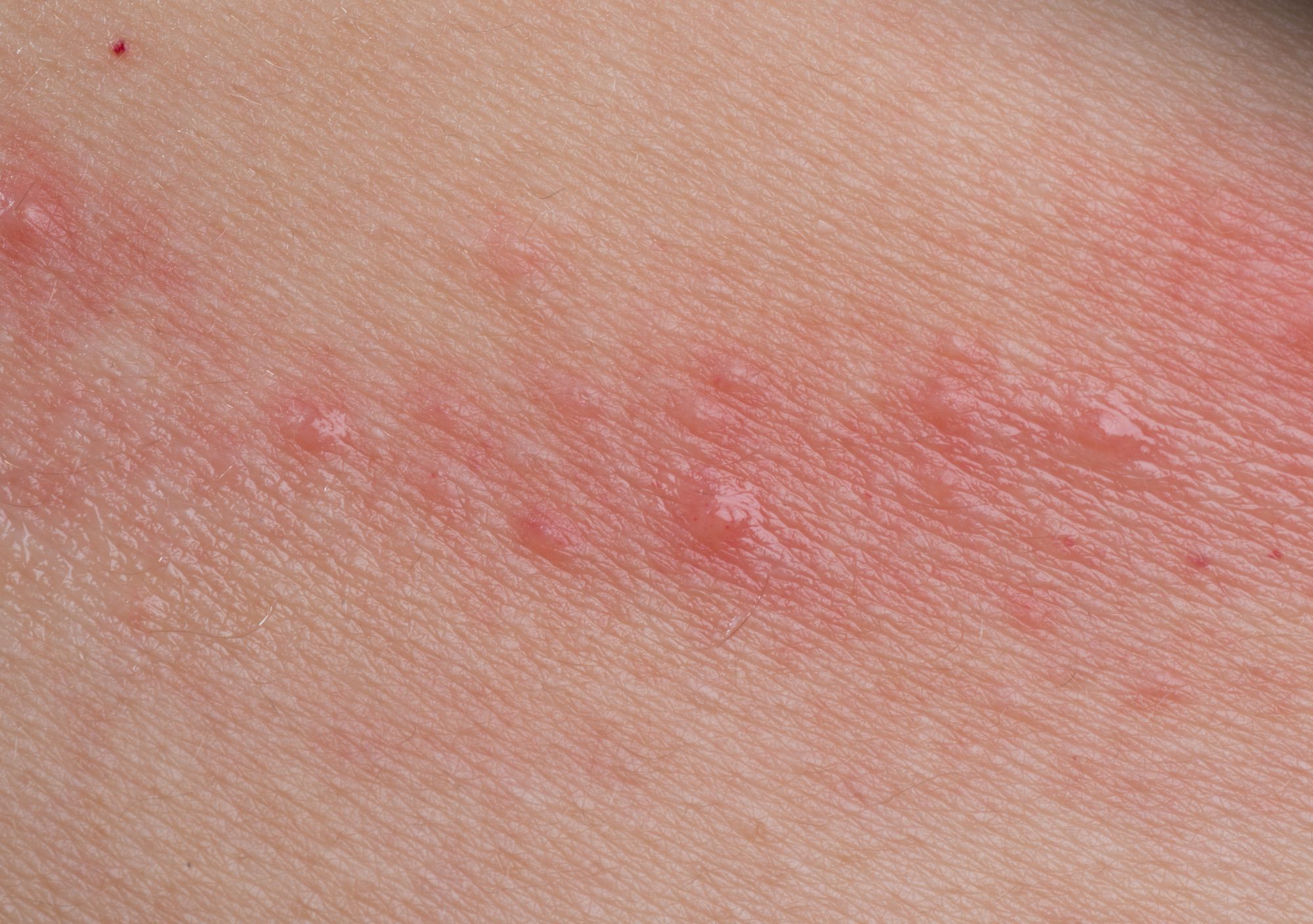 Understanding the Different Types of Skin Rashes